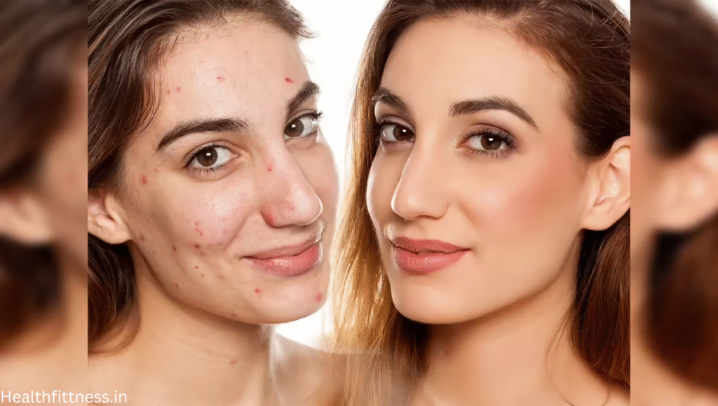 चेहरे पर पिंपल्स से छुटकारा पाने के 5 आसान और असरदार उपाय
